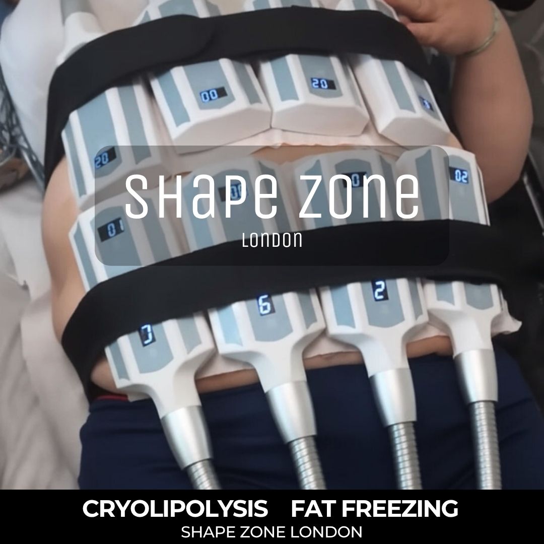 painless fat freezing london shape zone